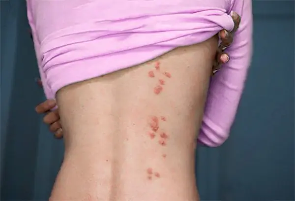 La espalda de una mujer con picaduras de chinches, levantando manchas rojas agrupadas, formando un patrón en zigzag